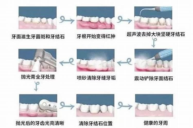 梦到洗牙